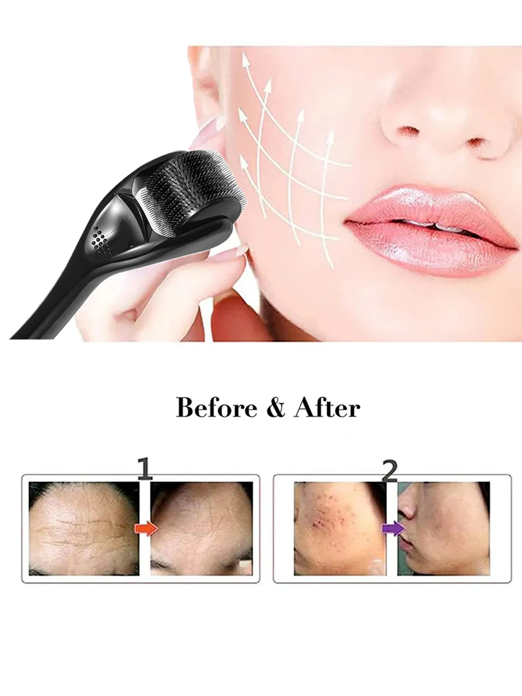 Derma Roller 540 Aiguilles – Anti-Cicatrices & Repousse – photo 8